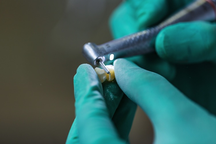 Der Eigenanteil der Patienten, den sie für Zahnersatz leisten müssen, ist laut PKV-Verband zuletzt deutlich gestiegen.