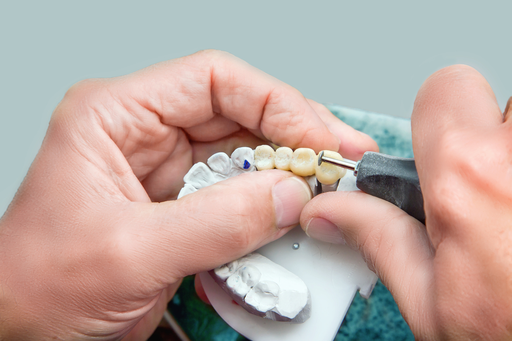 Zahnteilprothese wird auf einem Gebissmodell aus Keramik von einem Zahnarzt bearbeitet